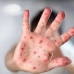 Confirman en CABA el primer caso en el país de la nueva cepa de viruela del mono